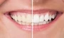 Teeth Bleaching Dental Service South Africa