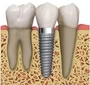 Dental Implant To Replace A Single Tooth