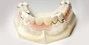 Cast Metal Partial Dentures In South Africa
